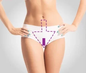 Virilha Cavada c/ Faixa Laser